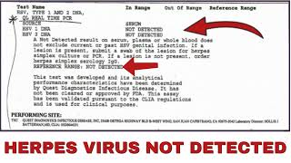 Herpes Simplex Virus NOT DETECTED Following Scalar Light Sessions  PCR Test Result [upl. by Janiuszck490]