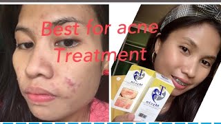 THE BEST FOR ACNE TREATMENT THE T3 MYCIN CLINDAMYCIN LOTION [upl. by Elehcar]