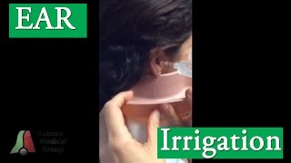 Ear Irrigation for Cerumen Ear Wax Removal  Auburn Medical Group [upl. by Harper]