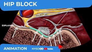 Hip Block  NYSORAs Reverse Ultrasound™ Animation [upl. by Zehc]