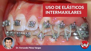 Uso de Elásticos Intermaxilares [upl. by Bridgid]