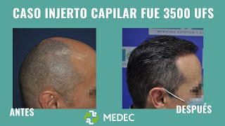 🙋‍‍CASO REAL de Injerto Capilar  3500 UFS  Resultados increíbles 👏‍‍ [upl. by Lewej]