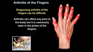 Arthritis Of The Fingers  Everything You Need To Know  Dr Nabil Ebraheim [upl. by Sirej]