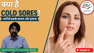 Cold Sores Explained by Dr Gurvinder Banga Causes Symptoms and Treatment [upl. by Hsirrap]