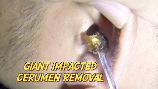 Giant Impacted Cerumen Removal [upl. by Eelatan]