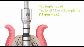 Straumann® PURE Ceramic Implant Monotype Step by Step [upl. by Koah842]