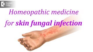 Homeopathic medicine for skin fungal infection  Dr Surekha Tiwari [upl. by Bruyn]