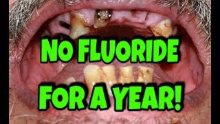 I STOPPED USING FLUORIDE FOR YEAR [upl. by Aeresed]