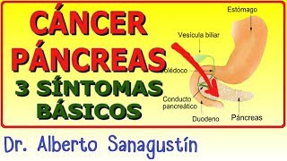 3 Síntomas del CÁNCER DE PÁNCREAS [upl. by Wojak]