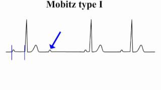 ECG Interpretation  AtrioVentricular Block [upl. by Matuag]