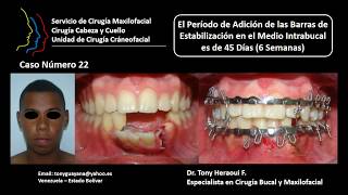 Tony Heraoui Cirugía Maxilofacial Caso 22 [upl. by Turpin]