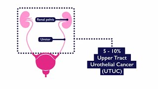 Papillary Thyroid Cancer Ultrasound [upl. by Nyra]