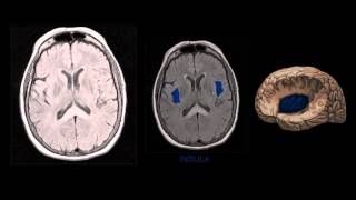 NEUROIMAGEM  Anatomia Cerebral na Ressonância Magnética [upl. by Adams]