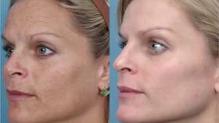 See What happend When She Applied these Ingredients on her dry Face [upl. by Shafer807]