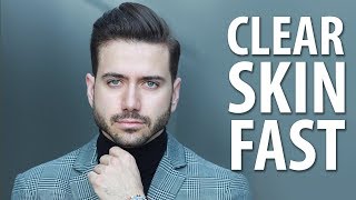 HOW TO GET CLEAR SKIN FAST  Mens Skincare Routine  ALEX COSTA [upl. by Rawlinson732]