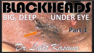 UNDER EYE DEEP BLACKHEADS PART 1 BY DRLALIT KASANA [upl. by Eenat]