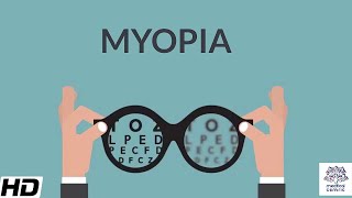 Myopia Signs and Symptoms Causes Diagnosis and Treatment [upl. by Erasaec699]