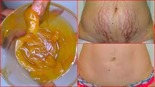 REMOVE STRETCH MARKS FAST HOW TO GET RID OF STRETCH MARKS EFFECTIVELY  Khichi Beauty [upl. by Mosenthal290]