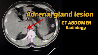 Adenoma adrenal avaliação pela RM [upl. by Anahcra693]