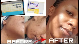 HOW I GOT RID OF MY ACNE  ACNETANE amp TETRALYSAL [upl. by Septima262]