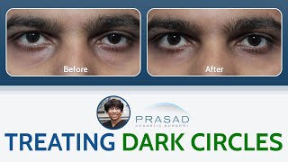 Treating Under Eye Dark Circles [upl. by Llehcor]