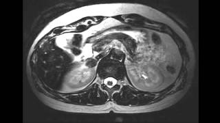 Adrenal adenoma [upl. by Goldsmith600]