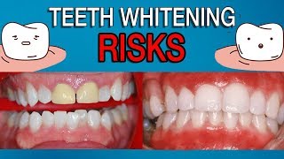 The Risks of Teeth Whitening [upl. by Alford]