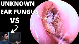 Ear Fungal Infection VS Audiologist [upl. by Goodhen639]