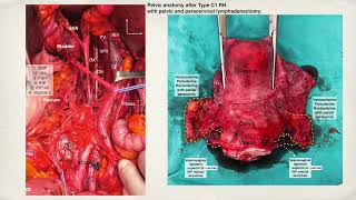 NerveSparing Radical Hysterectomy  Simplifying Type C1 RH by Dr Ilker SELCUK [upl. by Twelve548]