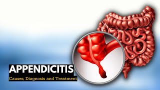 Appendicitis Causes Signs and Symptoms Diagnosis and Treatment [upl. by Htiduy611]