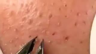 BLACKHEADS PULLING BY TWEEZERS [upl. by Georgette]