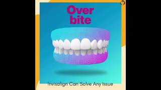 Overbite underbite teeth treatment [upl. by Tena635]