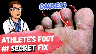 BEST Athletes Foot Fungus Treatments HOME Remedies  3 BIG SECRETS [upl. by Burnett]