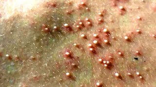 Solar Comedones Pimple Popping amp Big Blackheads  Week in Review [upl. by Savdeep932]