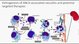 ANCA associated Vasculitis [upl. by Obla]