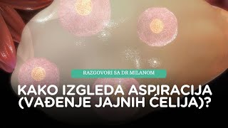 VTO Aspiracija vađenje jajnih ćelija [upl. by Gehlbach]