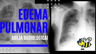 Edema pulmonar [upl. by Arhsub]