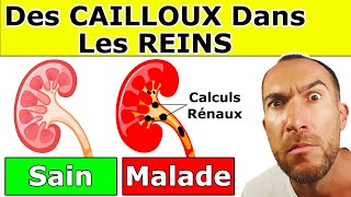 CALCULS RÉNAUX  Causes Symptômes Aliments Interdits et Remèdes Naturels [upl. by Nolahs]