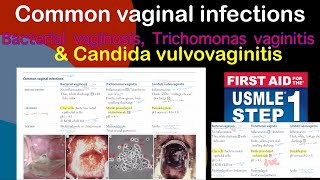 Common vaginal infections Bacterial vaginosis Trichomanas vaginitis amp Candida vulvovaginitis [upl. by Anayia947]