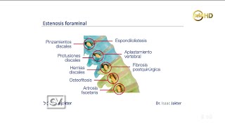 Dolor de espalda  Estenosis foraminal  Dr Isaac Jakter [upl. by Eniarrol141]