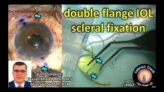 double flange IOL scleral fixation technique with singlepiece acrylic IOL [upl. by Federica]