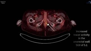 PSMA PETCT F18 Pylarify Case 5 [upl. by Benilda]