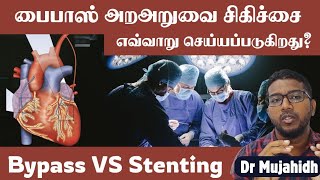 Stenting vs Bypass surgery in tamil  Bypass surgery எவ்வாறு செய்யப்படுகிறது Dr Mujahidh [upl. by Hedwig]