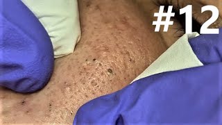 BLACKHEADS EXTRACTIONS on Happy 12 [upl. by Laith200]