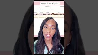 HOW TO REDUCE ACNE SCARS [upl. by Lacie]