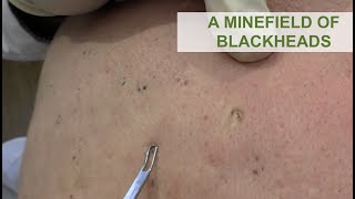 A Minefield of Blackheads  Dr Derm [upl. by Kruter]