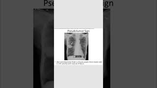 Pseudotumor signCHFradiology neetpg inicet shortsfeed [upl. by Ettegirb]