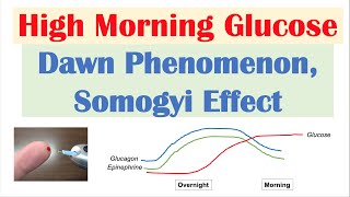 High Early Morning Glucose  Dawn Phenomenon amp Somogyi Effect [upl. by Ahsekyt678]