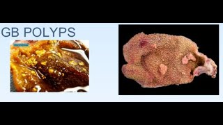 Gallbladder Polyps  What to do with them  Dr H V Shivaram [upl. by Asenej]