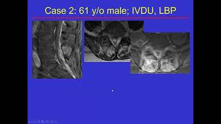 Imaging Spine infection [upl. by Lamej]